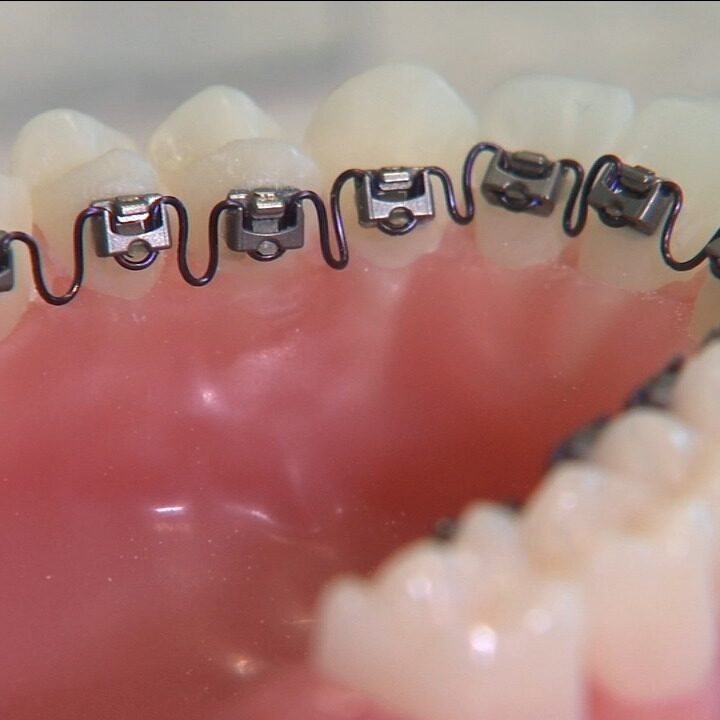 hidden braces